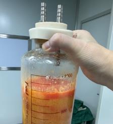 头条水动力吸脂手术要做多久？